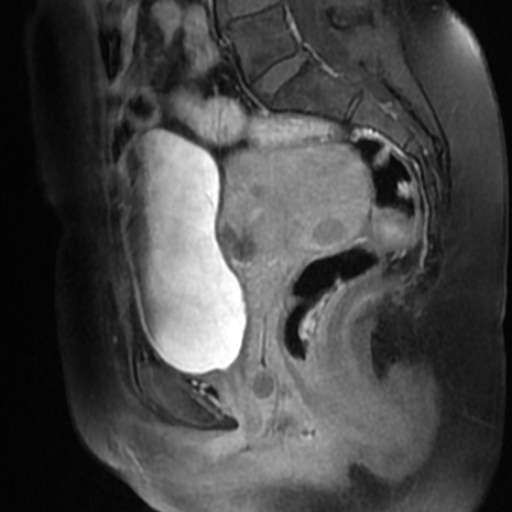 File:Adenoma malignum of cervix (Radiopaedia 66441-75705 Sagittal T1 C+ fat sat 10).jpg