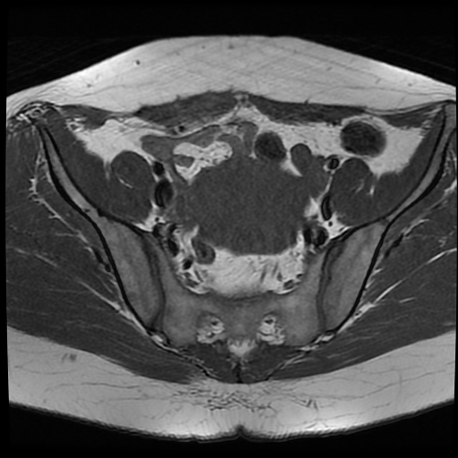 File:Adenomyosis-scar endometriosis (Radiopaedia 65863-75022 Axial T1 11).jpg