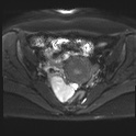 File:Adenomyosis and endometriotic cysts (Radiopaedia 82300-96367 Axial DWI 12).jpg