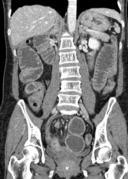 File:Adhesional small bowel obstruction (Radiopaedia 48397-53305 Coronal C+ portal venous phase 209).jpg