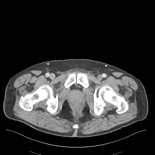 Adhesions within abdominal wall hernia (Radiopaedia 58283-65394 Axial C+ portal venous phase 84).png