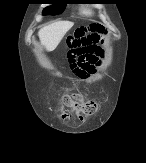 Adhesions within abdominal wall hernia (Radiopaedia 58283-65394 Coronal C+ portal venous phase 14).png