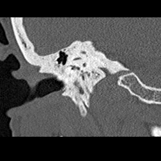 File:Adhesive chronic otitis media (Radiopaedia 14270-14148 Coronal bone window - right 15).jpg
