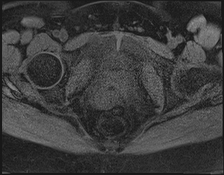File:Adnexal multilocular cyst (O-RADS US 3. O-RADS MRI 3) (Radiopaedia 87426-103754 Axial 202).jpeg
