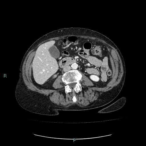 File:Adrenal collision tumor (ACT) (Radiopaedia 48462-53379 Axial C+ portal venous phase 30).jpg