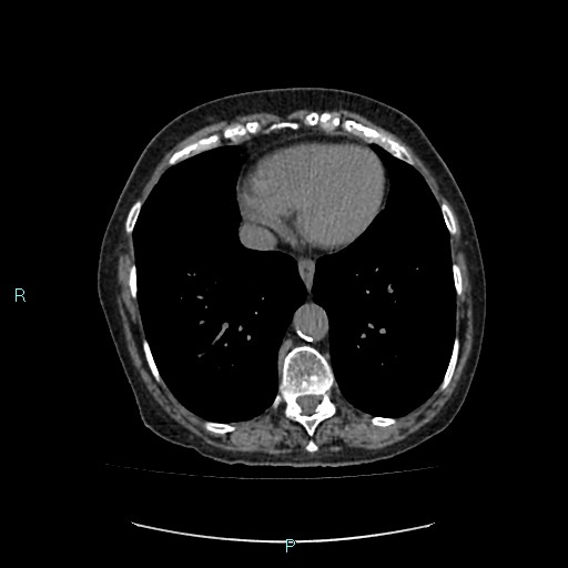 File:Adrenal collision tumor (ACT) (Radiopaedia 48462-53379 Axial non-contrast 1).jpg