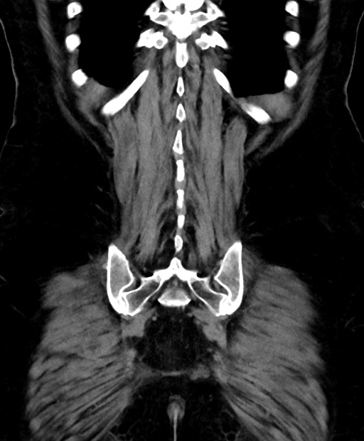 Adrenal cortical carcinoma (Radiopaedia 64017-72769 Coronal C+ delayed 52).jpg