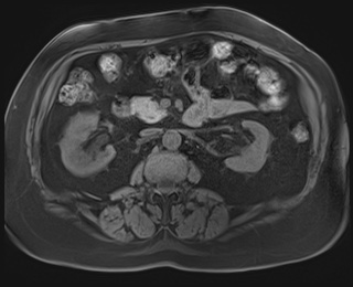 Adrenal cortical carcinoma (Radiopaedia 64017-72770 Axial T1 fat sat 44).jpg