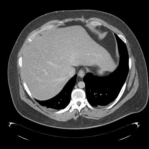 File:Adrenal cyst (Radiopaedia 45625-49776 Axial C+ portal venous phase 16).png