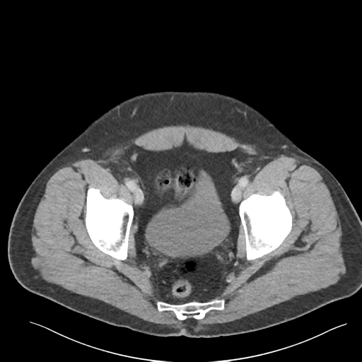 Adrenal cyst (Radiopaedia 45625-49777 Axial C+ portal venous phase 91).png