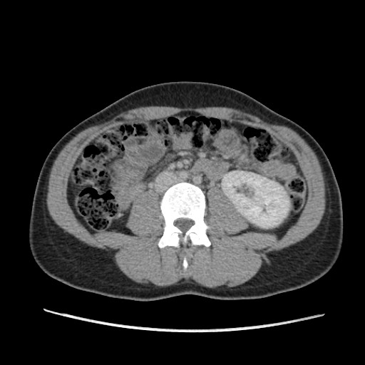 Adrenal cyst (Radiopaedia 64869-73813 Axial C+ portal venous phase 41).jpg