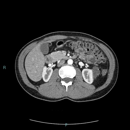 Adrenal cystic lymphangioma (Radiopaedia 83161-97534 Axial C+ arterial phase 39).jpg