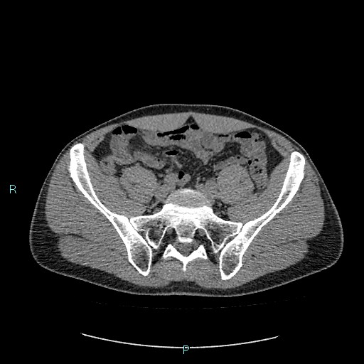 Adrenal cystic lymphangioma (Radiopaedia 83161-97534 Axial non-contrast 72).jpg
