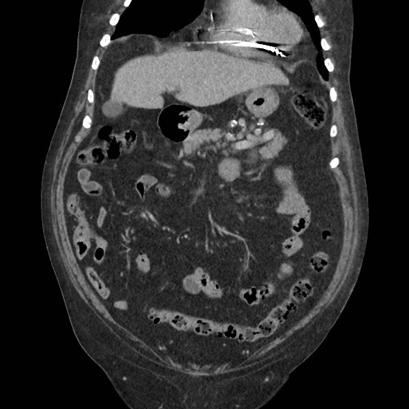 Adrenal lymphoma (Radiopaedia 84145-99415 Coronal C+ portal venous phase 25).jpg