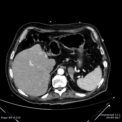 Adrenal metastasis (Radiopaedia 78425-91079 Axial C+ arterial phase 19).jpg