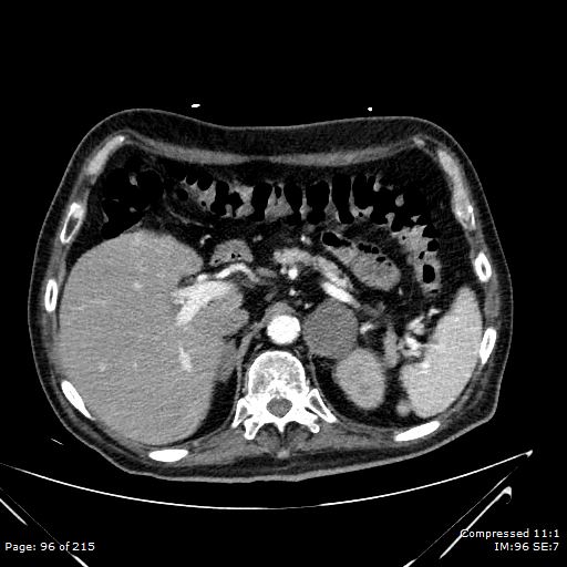 Adrenal metastasis (Radiopaedia 78425-91079 Axial C+ arterial phase 26).jpg