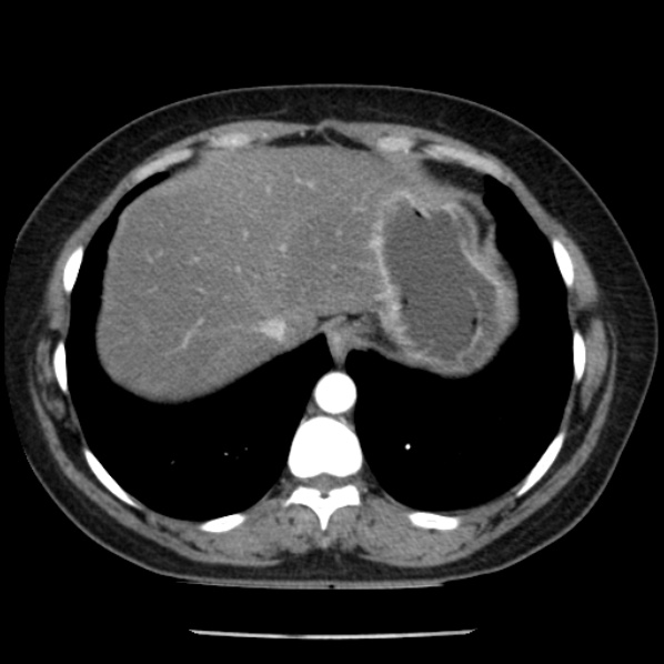 Adrenal myelolipoma (Radiopaedia 43401-46759 Axial C+ arterial phase 11).jpg