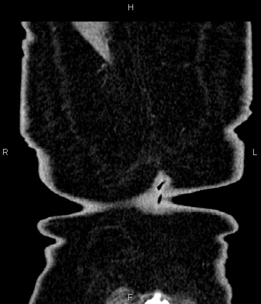 File:Adrenal myelolipoma (Radiopaedia 82742-96986 Coronal renal cortical phase 76).jpg