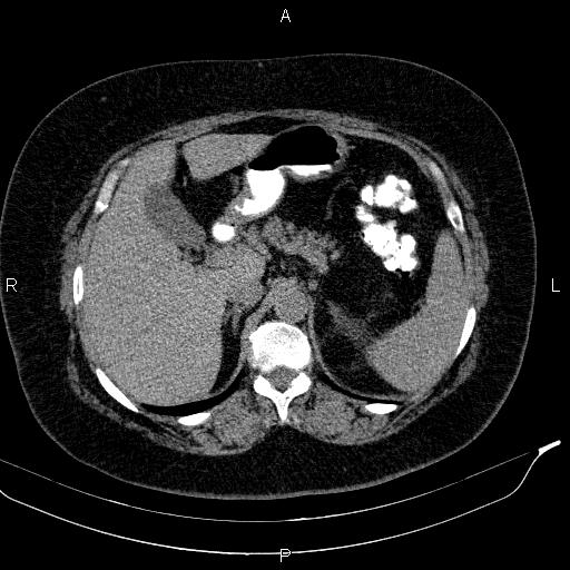 Adrenal myelolipoma (Radiopaedia 84319-99617 Axial With oral contrast 62).jpg