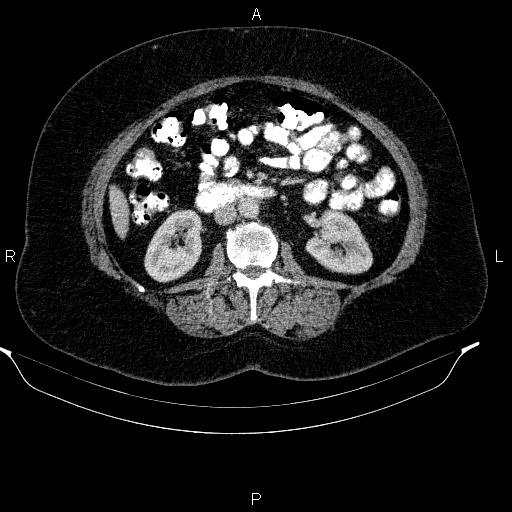 Adrenal myelolipoma (Radiopaedia 84319-99617 Axial renal cortical phase 55).jpg