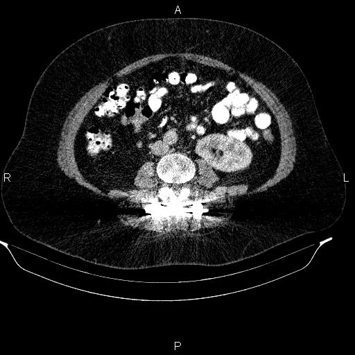Adrenal myelolipoma (Radiopaedia 84319-99617 Axial renal cortical phase 64).jpg