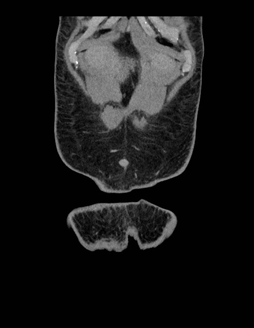 Adrenal myelolipoma - bilateral (Radiopaedia 74805-85810 Coronal C+ portal venous phase 246).jpg