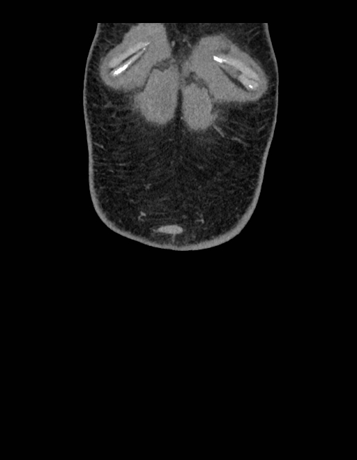 Adrenal myelolipoma - bilateral (Radiopaedia 74805-85810 Coronal C+ portal venous phase 256).jpg