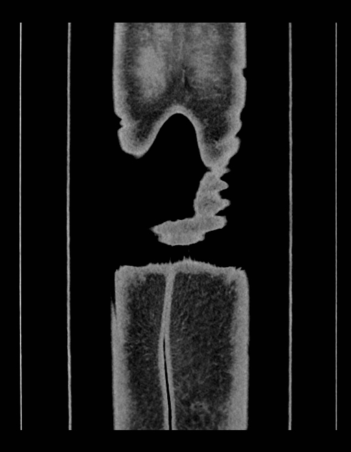 Adrenal myelolipoma - bilateral (Radiopaedia 74805-85810 Coronal C+ portal venous phase 27).jpg