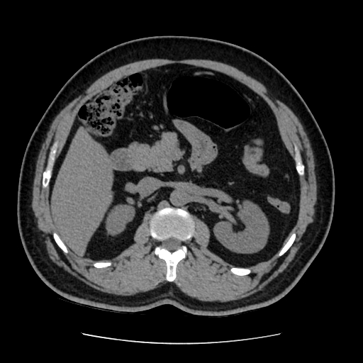 Adrenal myelolipoma and beaver tail liver (Radiopaedia 86201-102193 Axial non-contrast 178).jpg