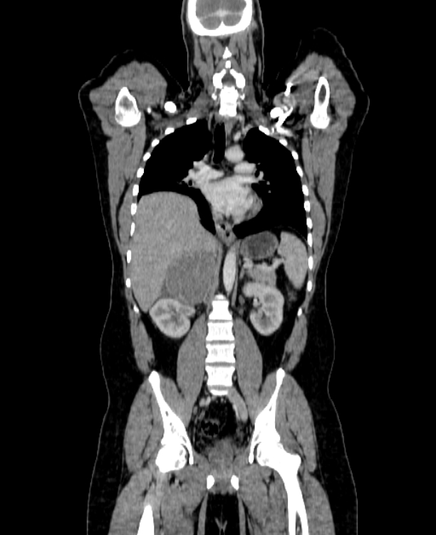 Adrenocortical carcinoma (Radiopaedia 80134-93438 Coronal C+ portal venous phase 97).jpg