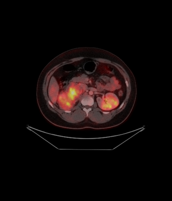 Adrenocortical carcinoma (Radiopaedia 80134-93440 ِAxial 174).jpg
