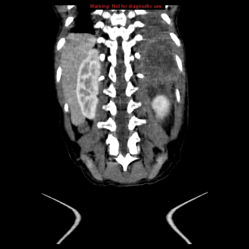 File:Adrenocortical carcinoma (Radiopaedia 9449-10131 Coronal C+ portal venous phase 18).jpg