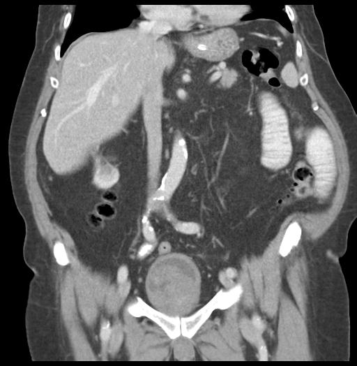 Adult ileal intussusception with secondary obstruction (Radiopaedia 30395-31051 Coronal C+ portal venous phase 31).jpg