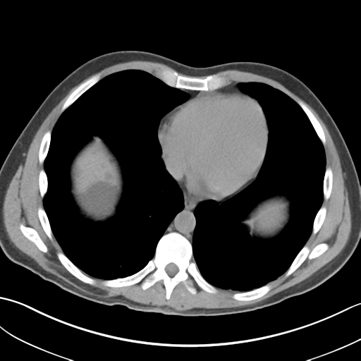 Adult polycystic kidney disease (Radiopaedia 47866-52626 Axial non-contrast 3).png