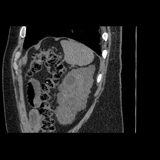 Adult polycystic kidney disease (Radiopaedia 59075-66368 Sagittal non-contrast 78).jpg