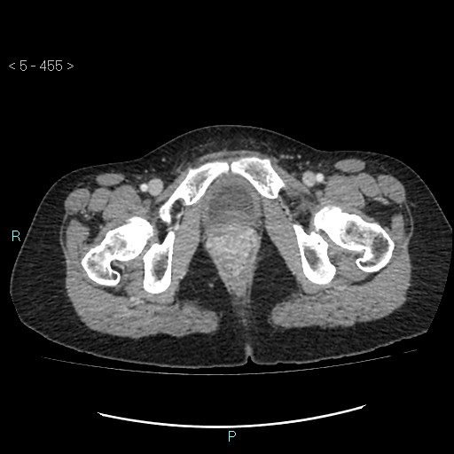 Adult transient intestinal intussusception (Radiopaedia 34853-36310 Axial C+ portal venous phase 123).jpg