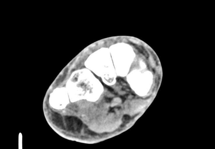 Advanced osteomyelitis due to open metatarsal fracture (Radiopaedia 83891-99095 Axial non-contrast 22).jpg