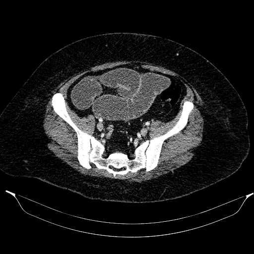 File:Afferent loop syndrome - secondary to incarcerated trocar site hernia (Radiopaedia 82959-97305 Axial C+ portal venous phase 183).jpg