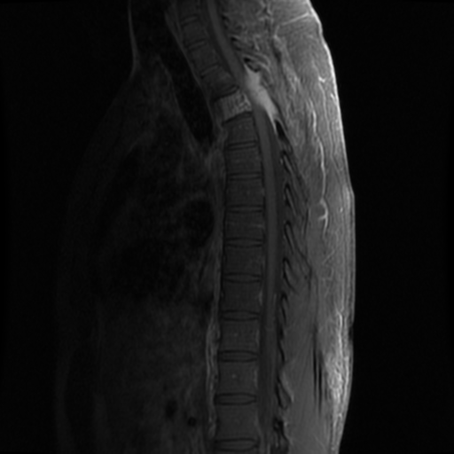 File:Aggressive vertebral hemangioma (Radiopaedia 39937-42404 B 13).png