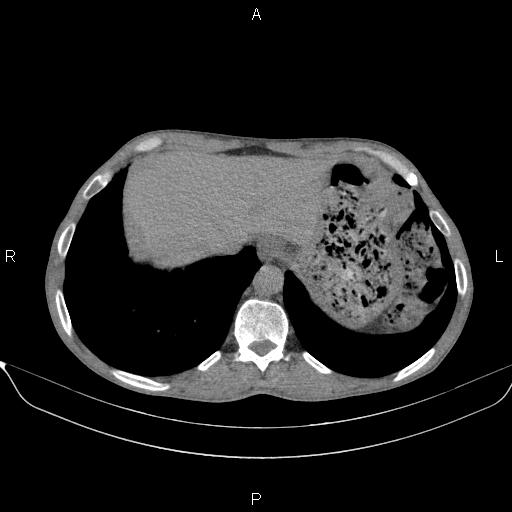 Air bronchogram in pneumonia (Radiopaedia 85719-101512 Axial non-contrast 58).jpg