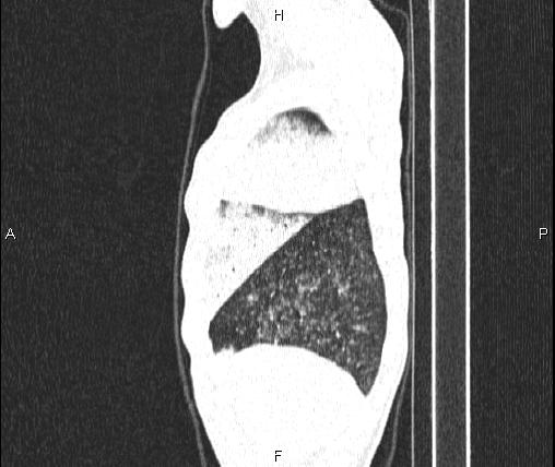 File:Air bronchogram in pneumonia (Radiopaedia 85719-101512 Sagittal lung window 12).jpg