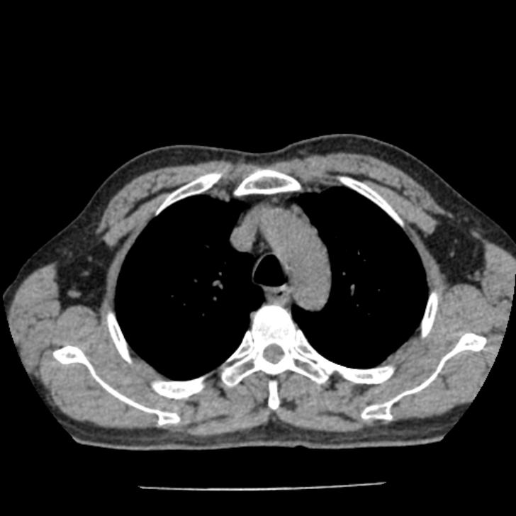 Airway foreign body in adult (Radiopaedia 85907-101779 Axial liver window 32).jpg
