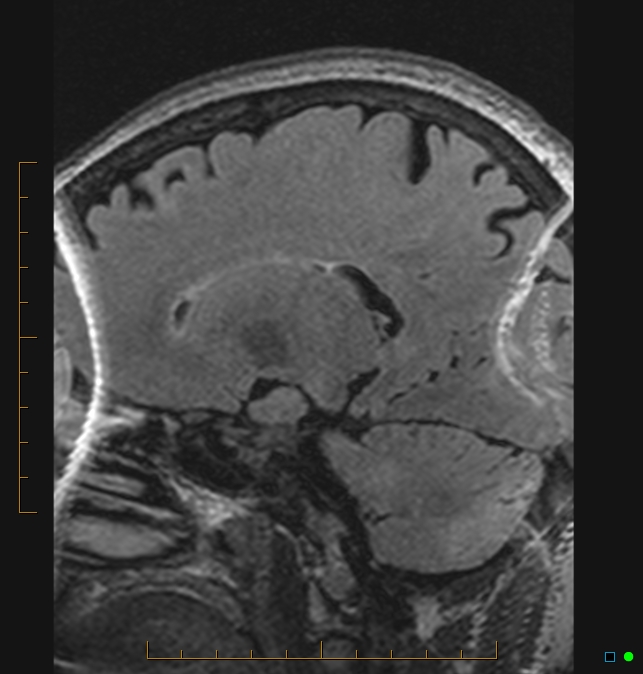 Aliasing artifact causing a spurious cerebellar lesion (Radiopaedia 48783-53810 Sagittal FLAIR 70).jpg