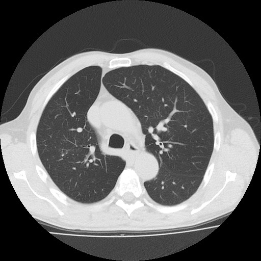 Allergic bronchopulmonary aspergillosis (ABPA) (Radiopaedia 60594-68313 Axial lung window 20).jpg