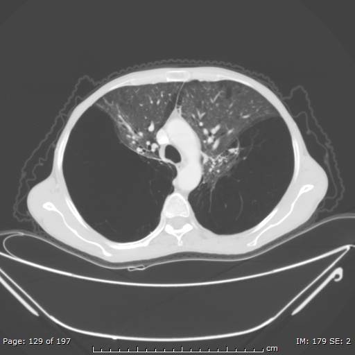 Alpha-1-antitrypsin deficiency (Radiopaedia 50561-55987 Axial lung window 54).jpg