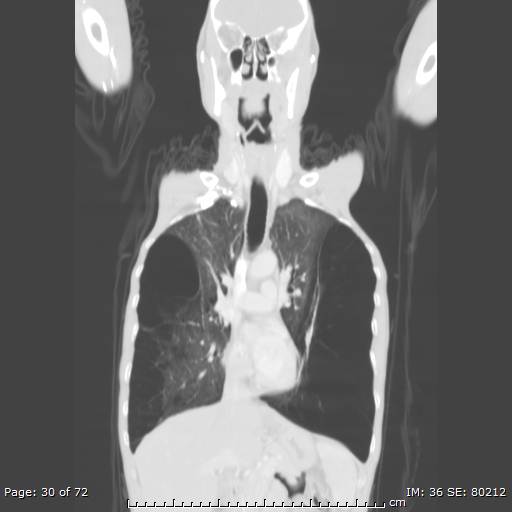 Alpha-1-antitrypsin deficiency (Radiopaedia 50561-55987 Coronal lung window 28).jpg