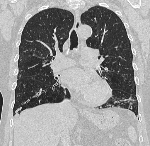 Alpha-1-antitrypsin deficiency (Radiopaedia 72058-82557 Coronal lung window 40).jpg