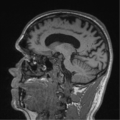 Alzheimer's disease- with Gerstmann syndrome and dressing apraxia (Radiopaedia 54882-61150 Sagittal T1 42).png