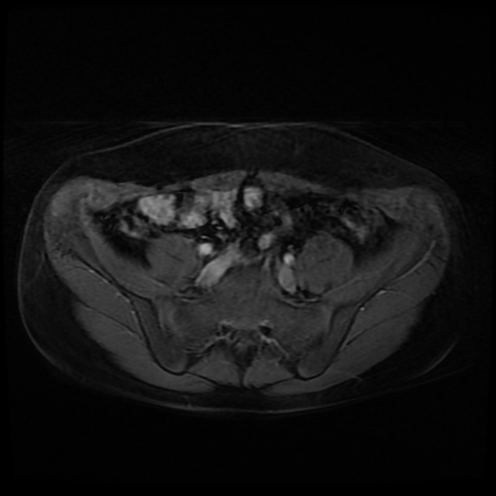 Ambiguous genitalia (Radiopaedia 69686-79643 Axial T1 C+ fat sat 3).jpg