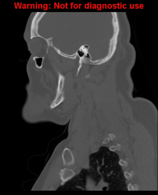 Ameloblastoma (Radiopaedia 33126-34164 Sagittal bone window 54).jpg